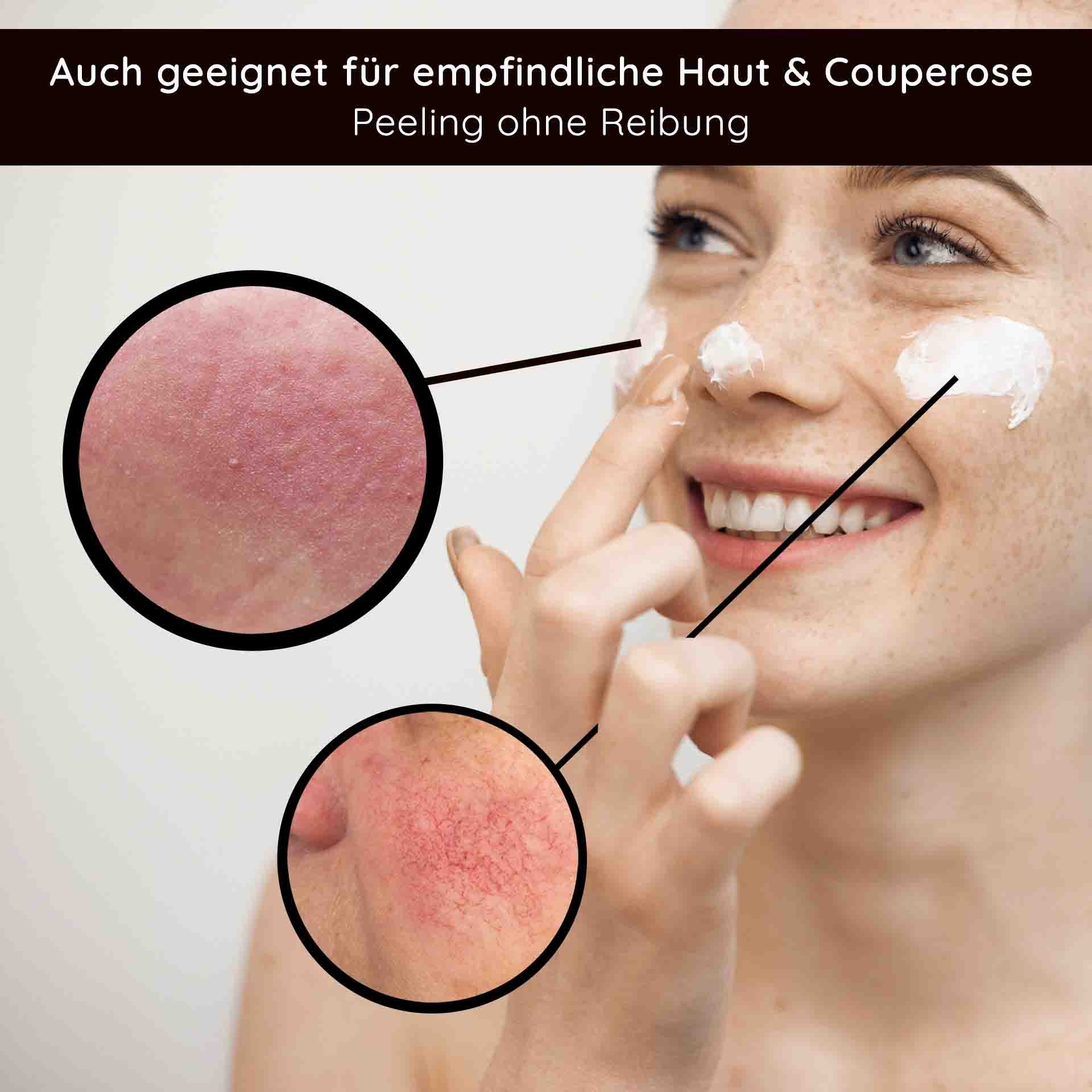 Mujer con sonrisa alegre aplicándose un exfoliante de ácidos frutales en el rostro, con primeros planos de piel sensible y rojeces, adecuado para piel sensible y couperosis, exfoliación sin fricción.