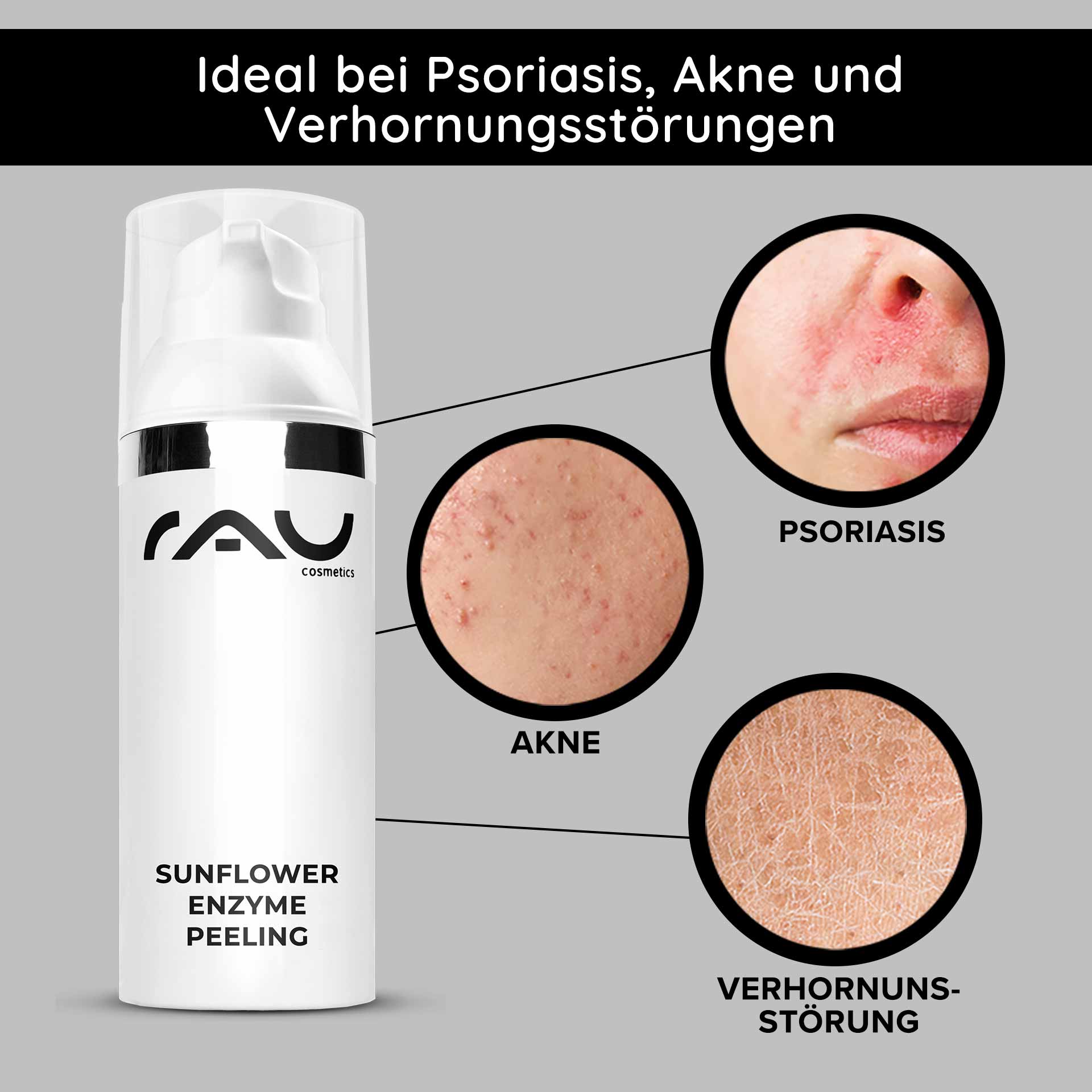 Peeling enzimático de girasol 50 ml Peeling enzimático químico Verpackung des Sunflower Enzyme Peeling von RAU Cosmetics mit hervorgehobenen Hautproblemen: Schuppenflechte, Akne und Hyperkeratose.