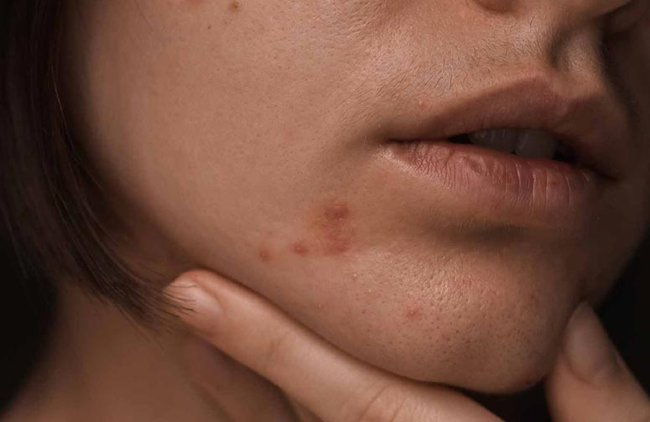 Periorale Dermatitis - Ursachen und Behandlung der Mundrose