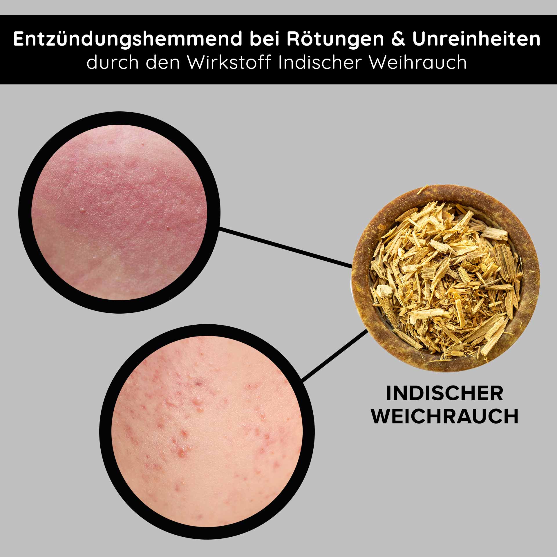 Tri peeling 50 ml enzyme & fruit acid peeling Entzündungshemmendes Indischer Weihrauch zur Reduzierung von Rötungen und Unreinheiten, mit Nahaufnahmen von betroffener Haut.