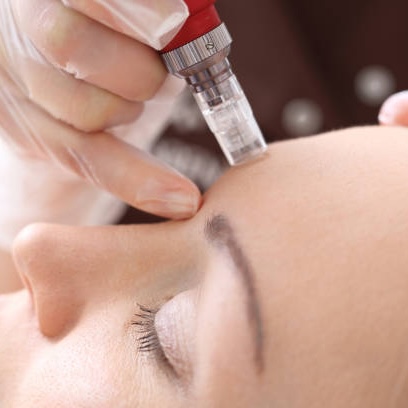 microneedling_gegen_falten