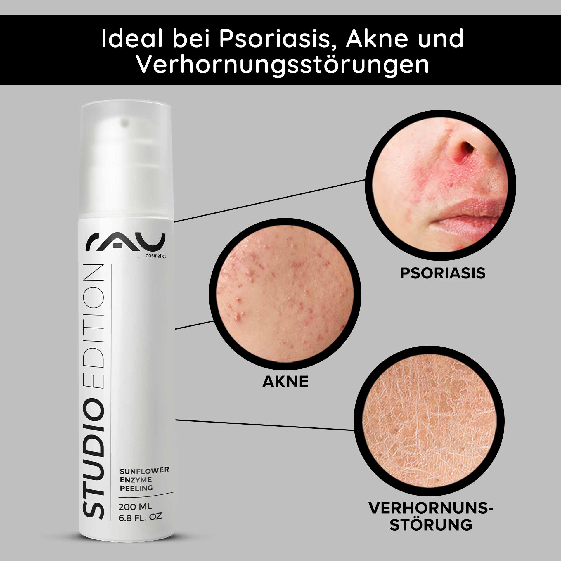 Peeling enzimático de girasol 200 ml Peeling enzimático químico Verpackung des RAU Sunflower Enzyme Peeling mit hervorgehobenen Vorteilen bei Schuppenflechte, Akne und Keratose; Nahaufnahmen von Hautzuständen veranschaulichen die Wirksamkeit.