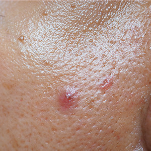 Nahaufnahme von Haut mit Poren und Rötungen zur Vermarktung des RAU Cosmetics Powersets für unreine Haut.