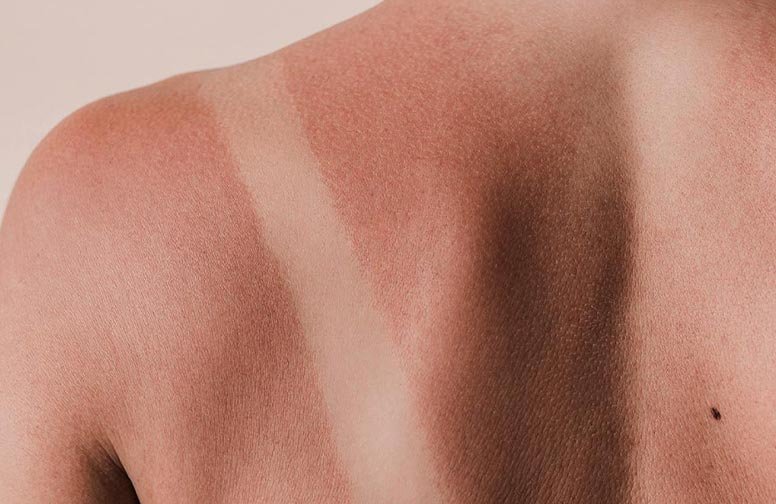 Sonnenbrand auf der Schulter mit deutlichem Farbunterschied zwischen gebräunter und ungeschützter Haut, passend zum Thema After Sun Pflege und Sonnenbrandbehandlung.