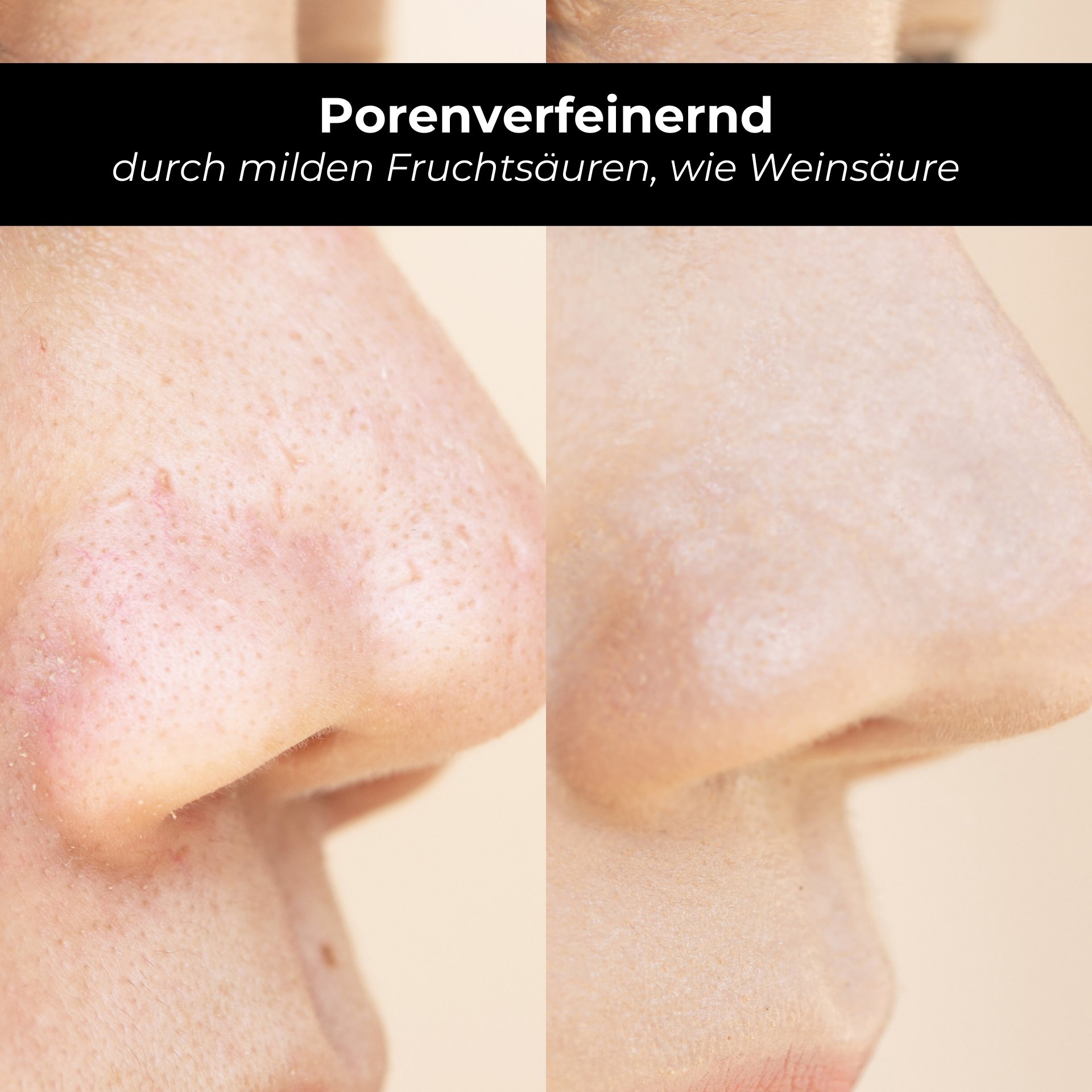 Porenverfeinerndes Hautbild durch milde Fruchtsäuren, wie Weinsäure, vor und nach Anwendung des RAU AHA Tonic.